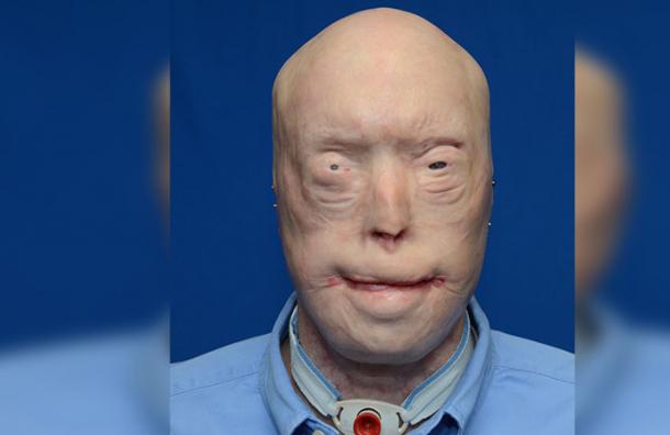 A un año de su trasplante de cara: Así se ve el hombre que quedó sin rostro tras un incendio